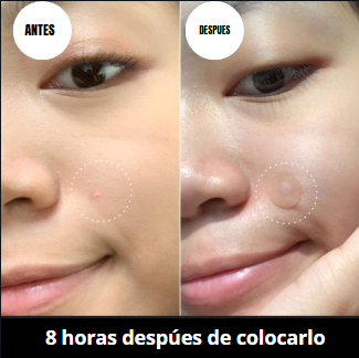 AcnéPro: Parches Invisibles, Resultados Reales